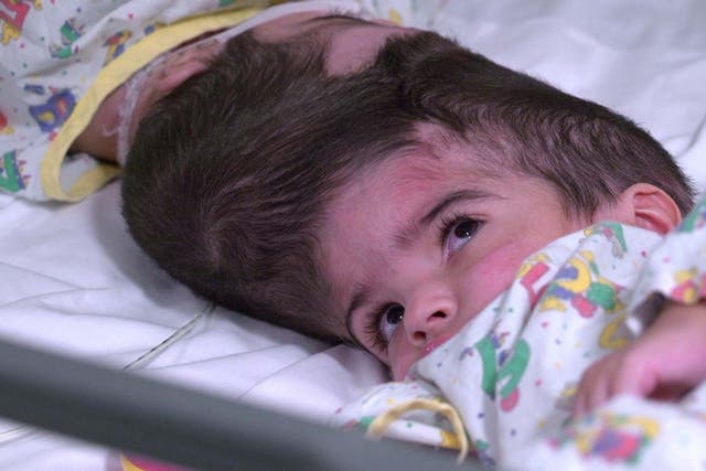 Two-year-olds Safa and Marwa Ullah, from Charsadda, Pakistan, before a surgery to separate their heads at Great Ormond Street Hospital, in London.