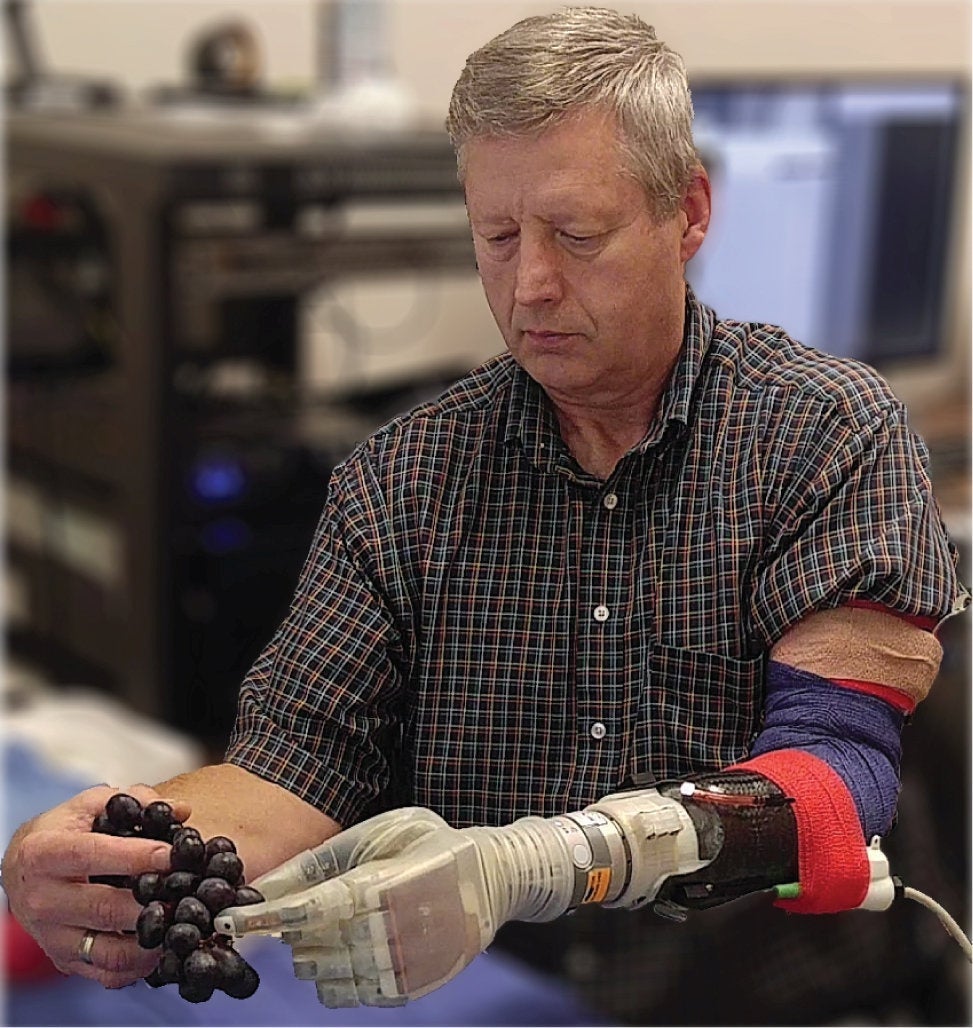 The motorised prosthetic has been named Luke after the prosthetic arm used by Star Wars character Luke Skywalker (University of Utah)
