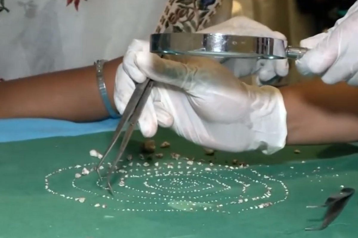 Child has 526 ‘teeth’ removed from mouth | The Independent | The ...
