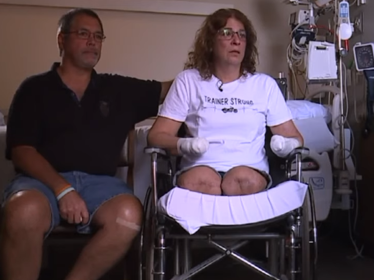 California mum has her arms and legs amputated after eating