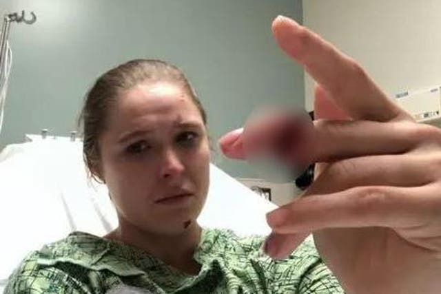 Ronda Rousey shows off her injury