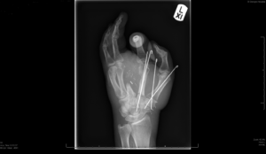 Mr Lelliott’s hand after surgery