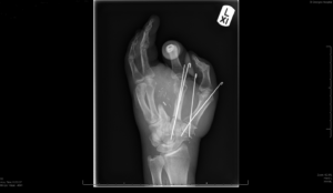 Mr Lelliott’s hand after surgery