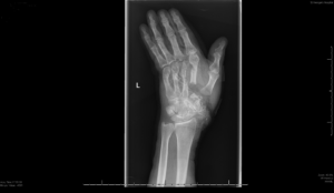 An x-ray of Mr Lelliot's hand immediately after the accident
