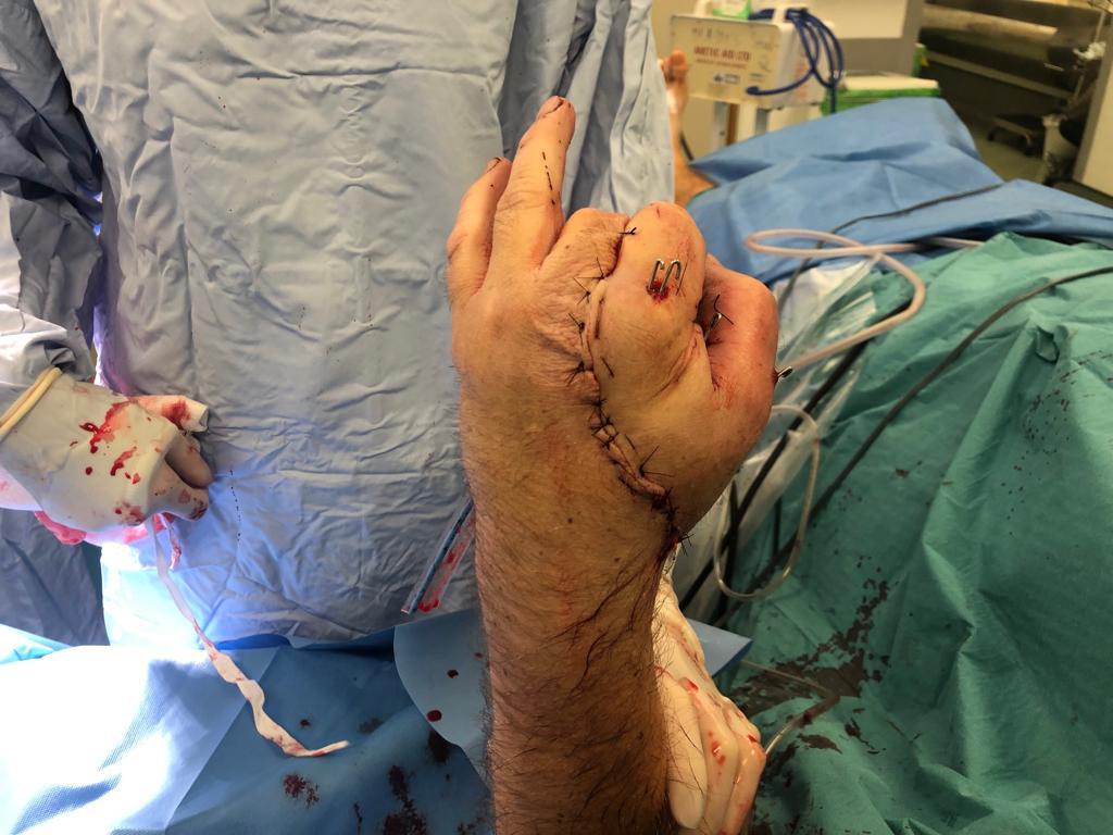 Surgeons at St George’s Hospital in Tooting spent around 17 hours in total operating on Anthony Lelliott’s left hand in an effort to salvage what they could