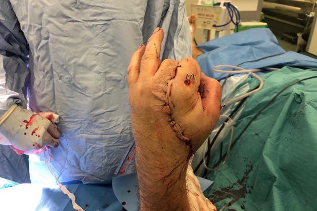 Surgeons at St George’s Hospital in Tooting spent around 17 hours in total operating on Anthony Lelliott’s left hand in an effort to salvage what they could