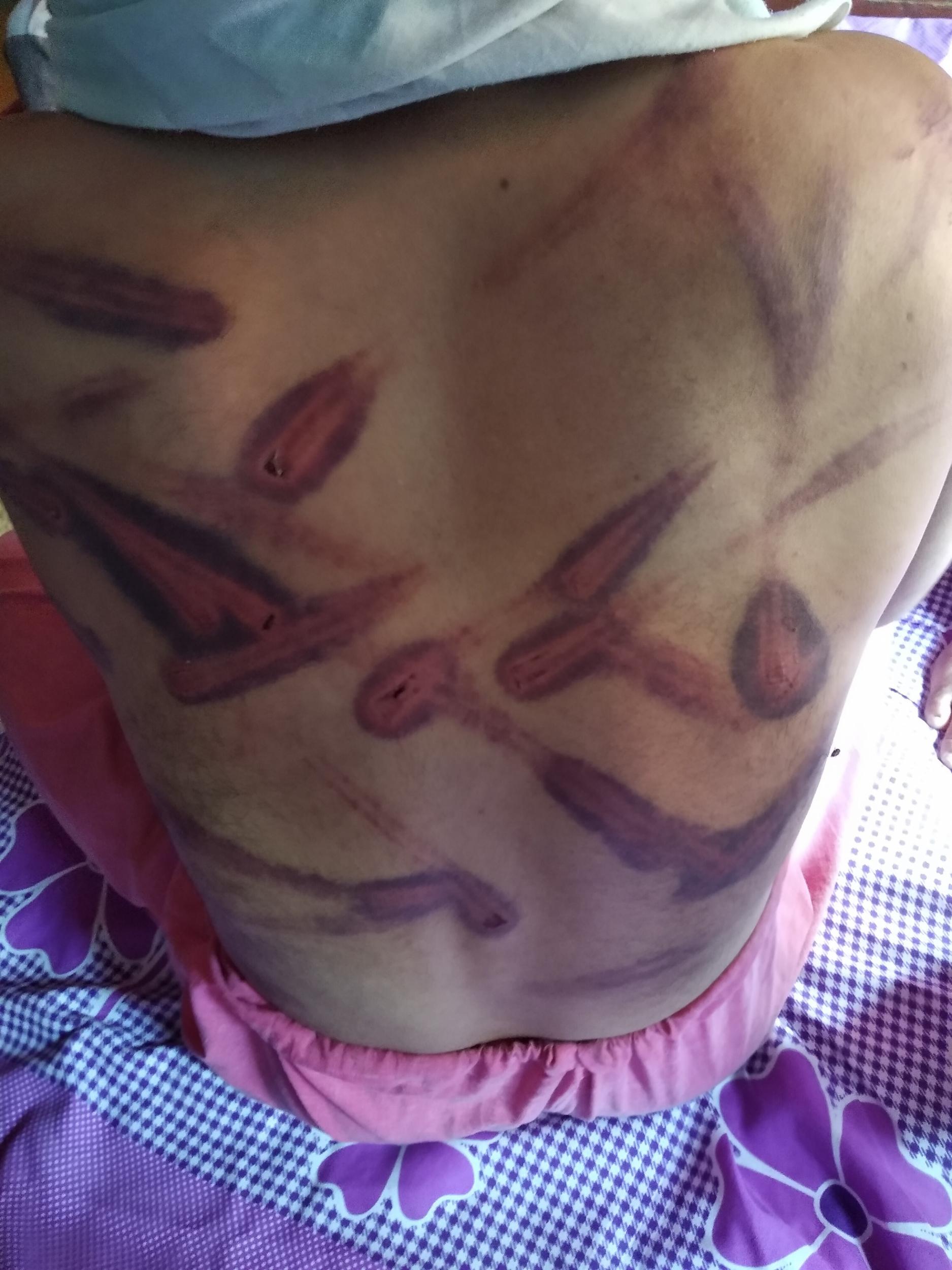 A young man's back after beatings by the security forces in August