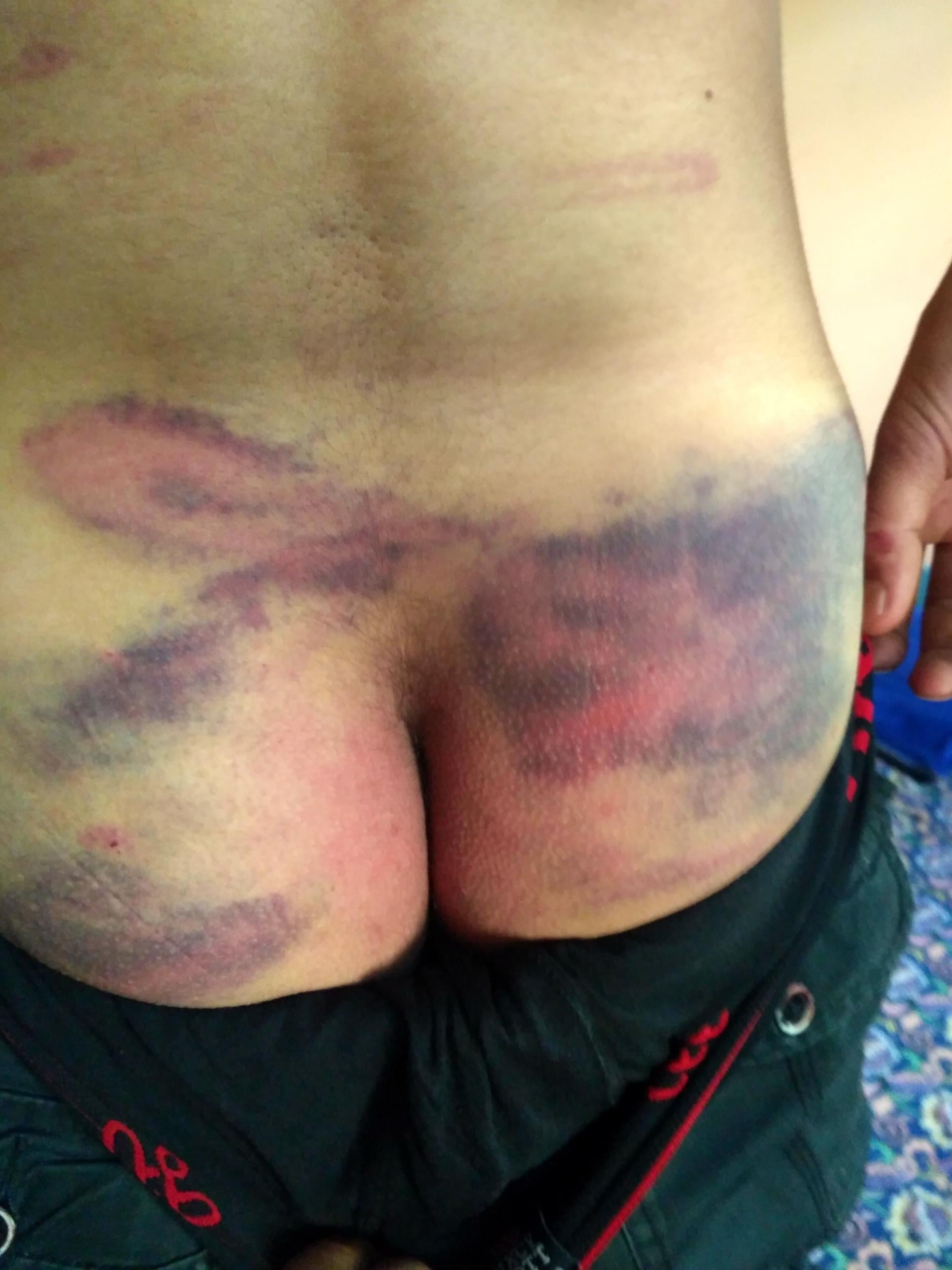 Yasin’s lower back, badly discoloured by bruising (Mohammad Yasin Bhat)