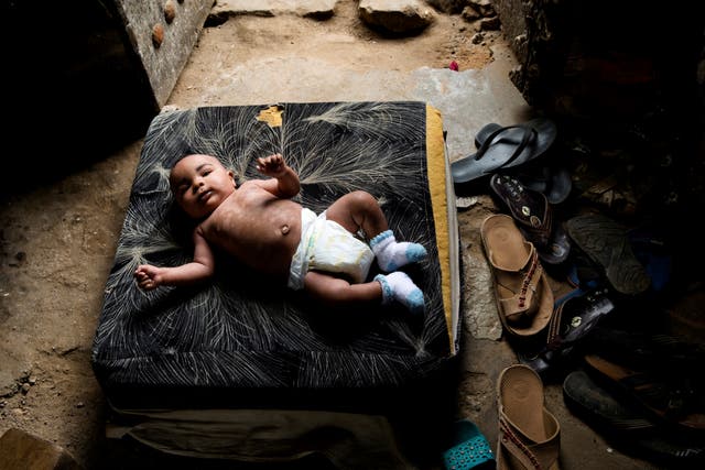 Ahee Bom lays on a cushion in the hallway of his home in Zanzibar. After birth, Ahee's skin began to significantly darken and peel off in large strips