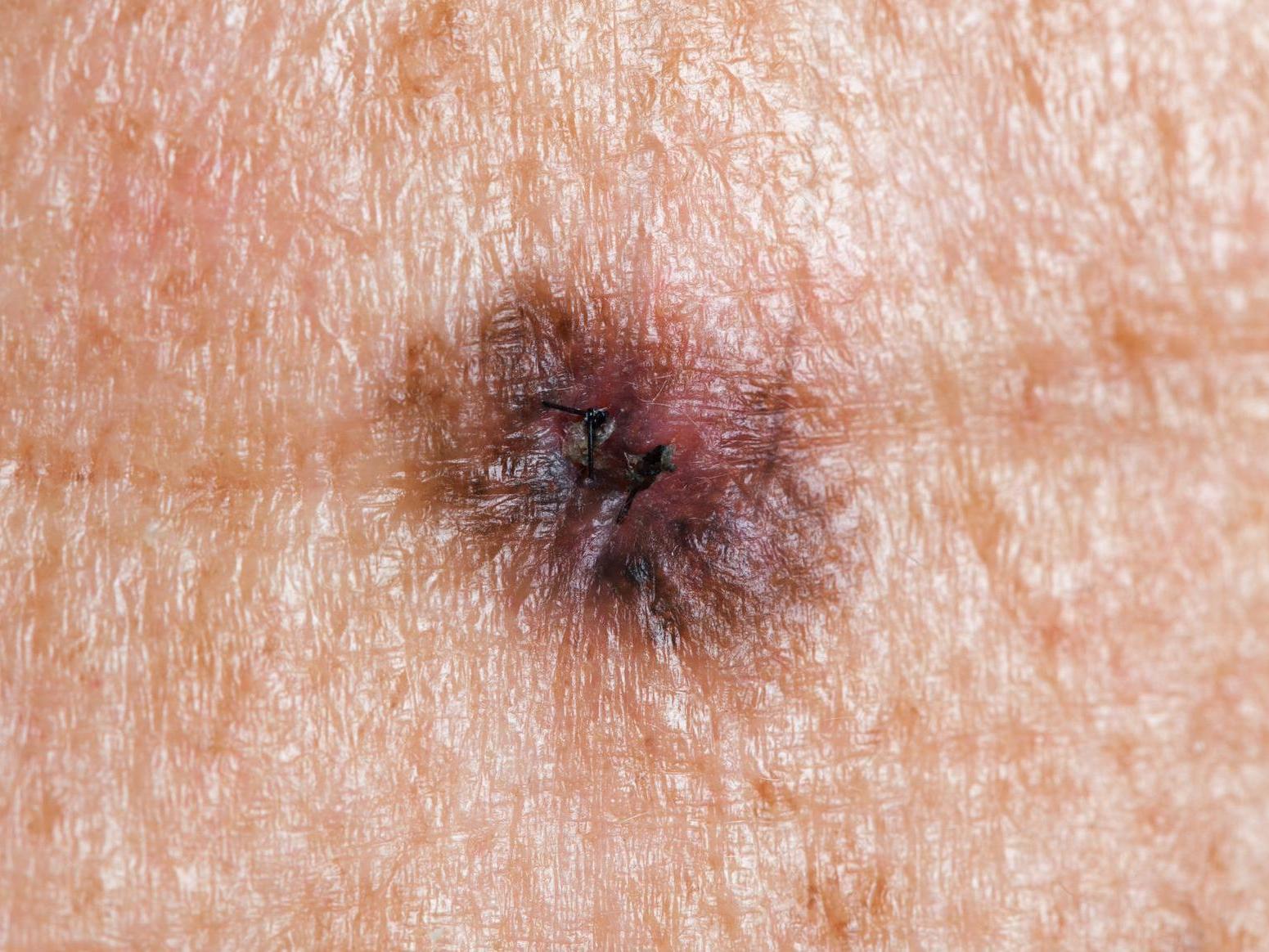 Melanoma is a form of skin cancer that accounts for more than 2,000 deaths in the UK every year