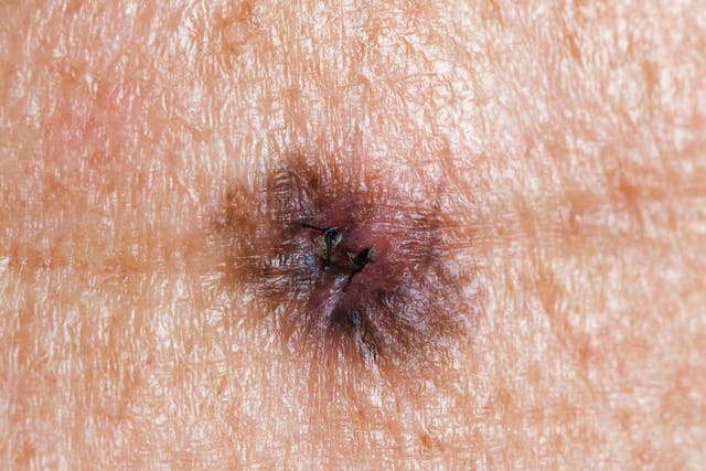 Melanoma is a form of skin cancer that accounts for more than 2,000 deaths in the UK every year