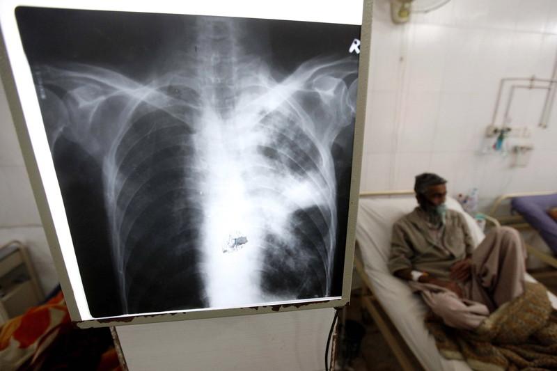 A patient suffering from TB blows air as part of the treatment at a hospital in Pakistan