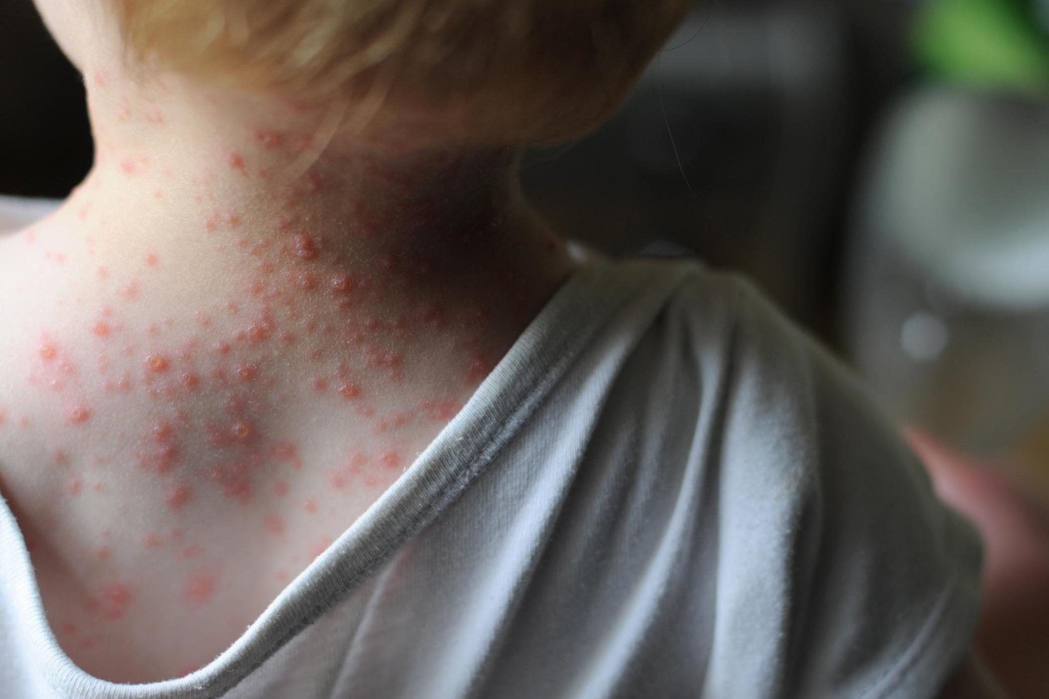 If you’ve ever had chickenpox, the shingles virus will be living in nerves near your spinal cord waiting to be triggered (Getty)