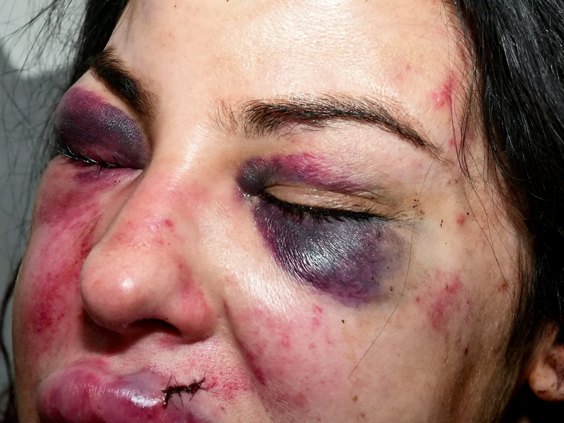 Ms Rechelle was beaten badly during the attack