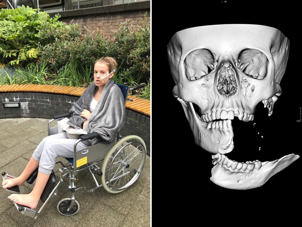 Teenager’s jaw ripped off in ‘warzone’ injury during horse riding accident