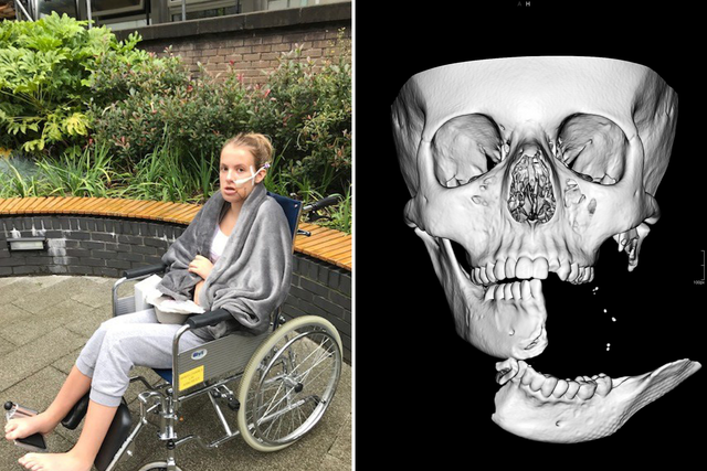 Emily Eccles, 15, was left with just one centimetre of skin keeping her lower jaw attached to her head after smashing into a gatepost while horse riding in the Peak District in August 2019.
