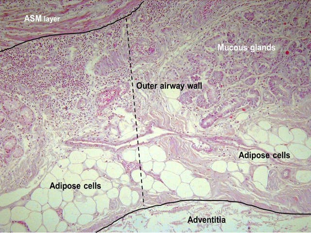Pictured is accumulation of fat (adipose cells) on the airway inside the lungs of someone who died from an asthma attack 