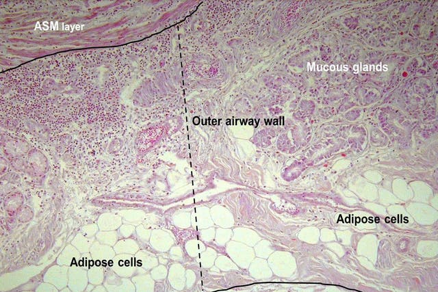 Pictured is accumulation of fat (adipose cells) on the airway inside the lungs of someone who died from an asthma attack 