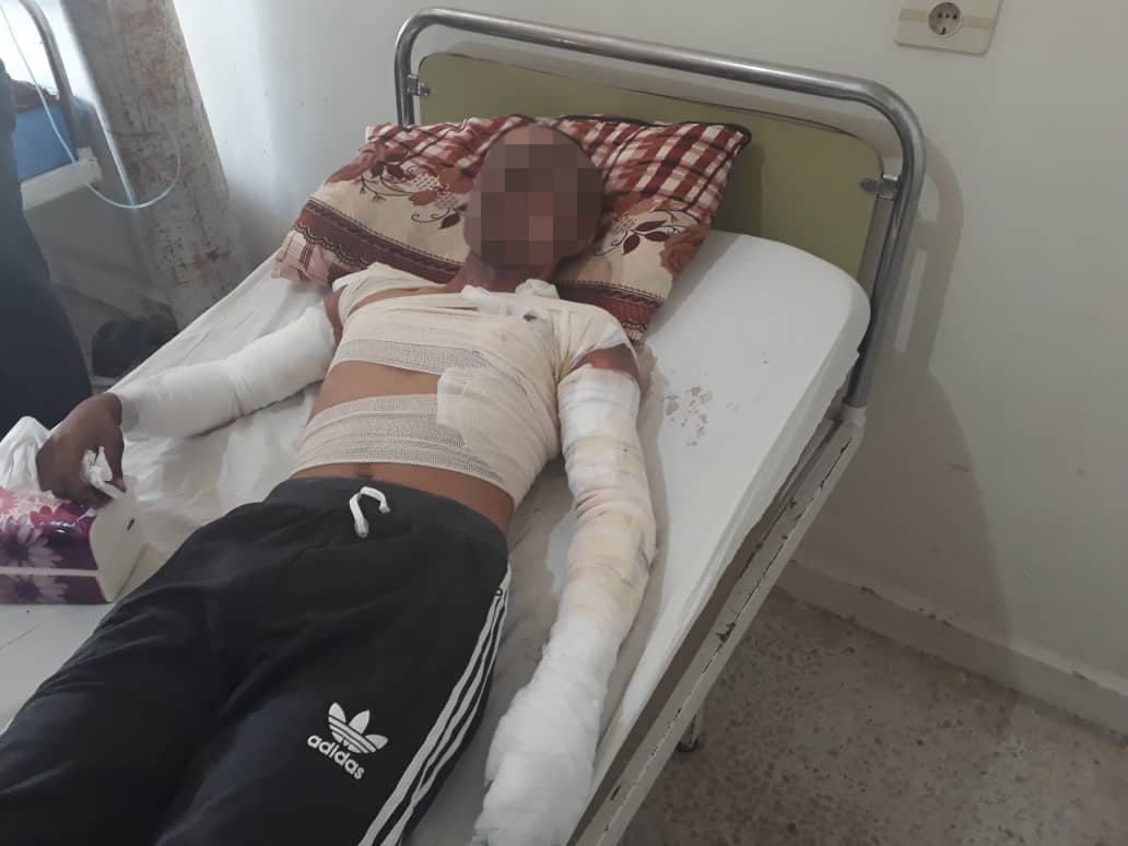 A severely burnt young man being treated in Hasakah