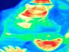 Woman’s breast cancer detected by thermal imaging scan
