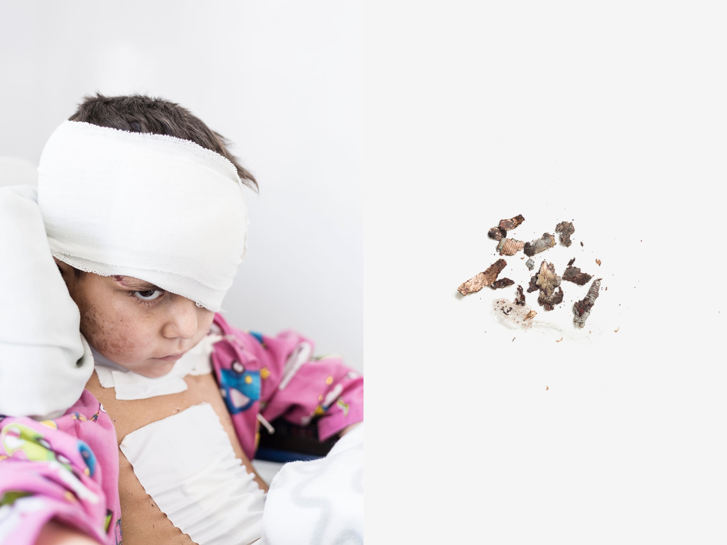 Mafton, 5, wounded in a clash between the Afghan army and Taliban militias in Tagab district, in Kapisa province. When a rocket exploded, he lost his left eye and his chest was wounded all over