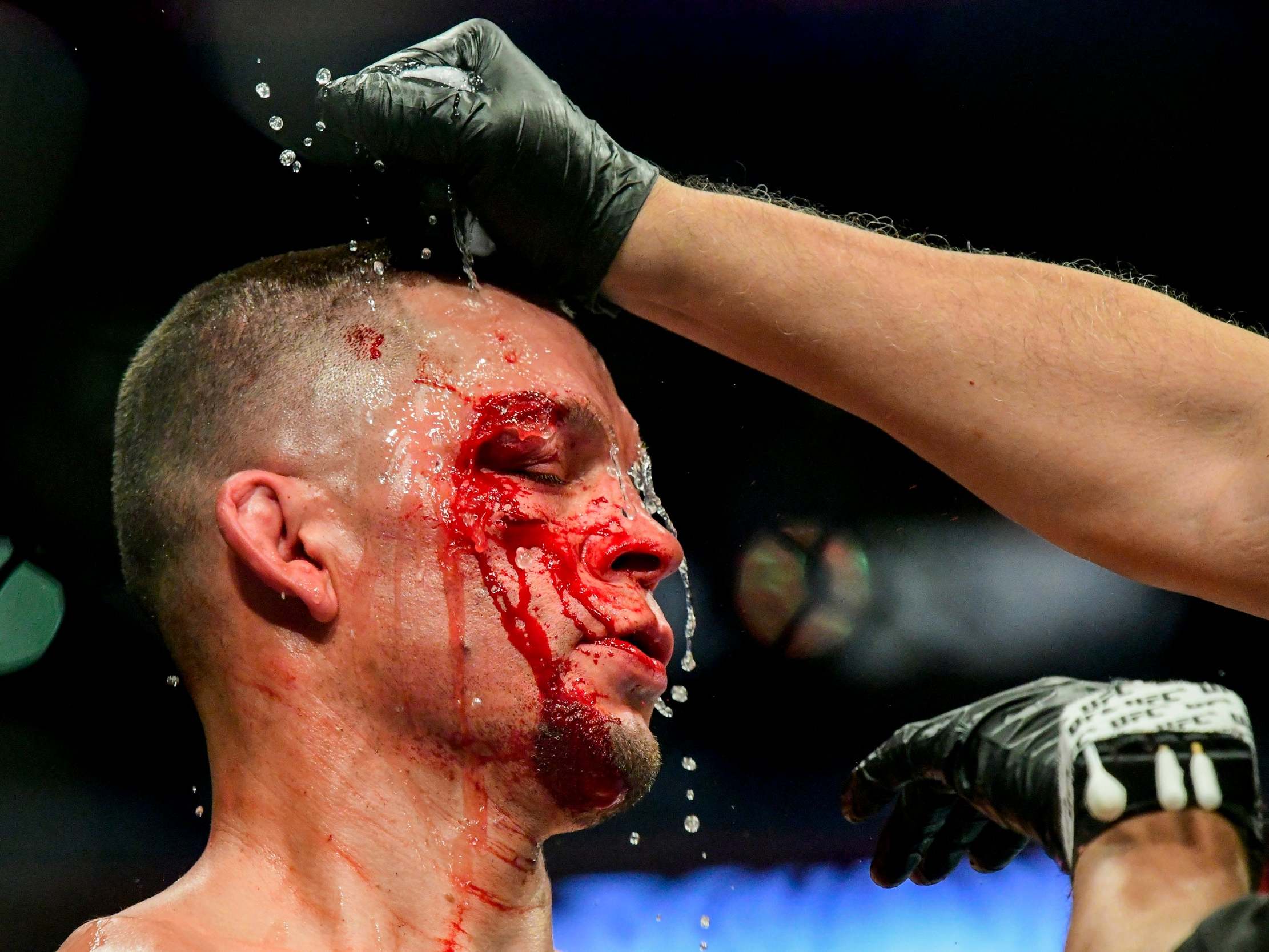 Diaz received cuts above and below the eye against Masvidal