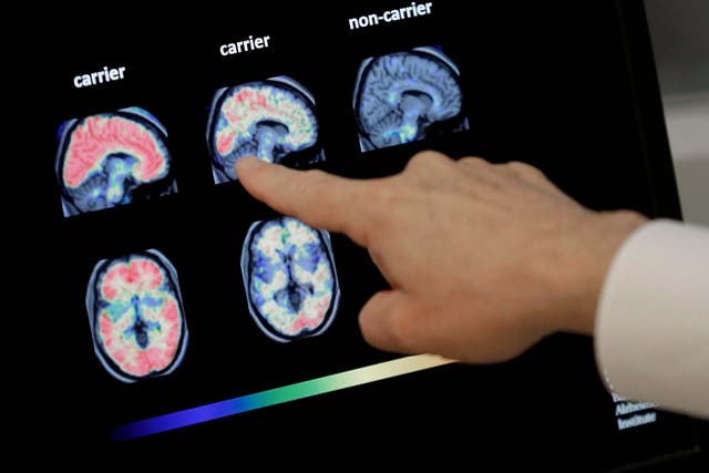 Likelihood of developing Alzheimer's can be determined by a person's genetic profile