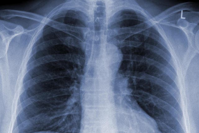 Poorest areas hardest hit by 'forgotten epidemic' of pneumonia