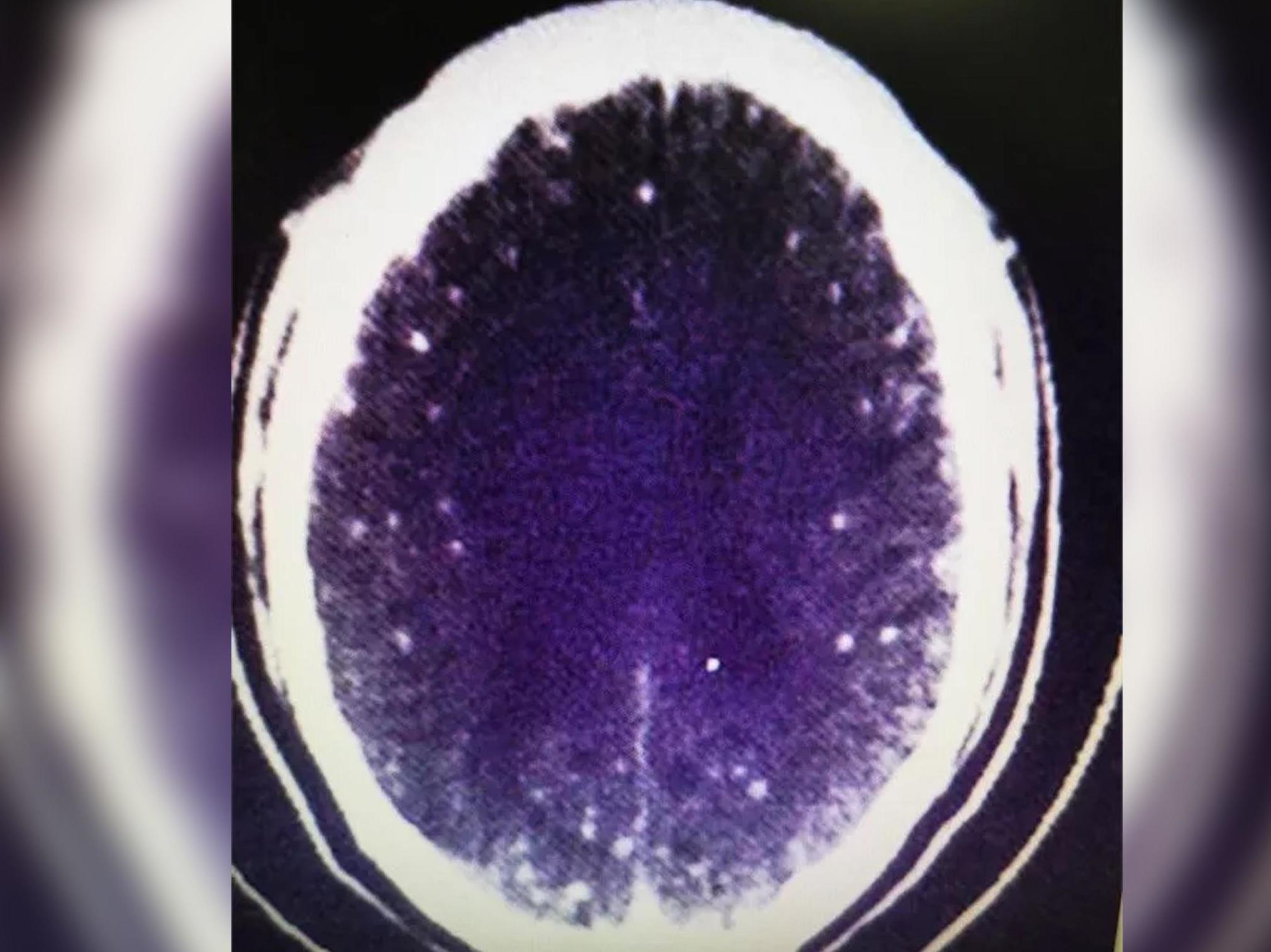 Scans found Zhu's epilepsy-like conditions were caused by hundreds of tapeworm larvae