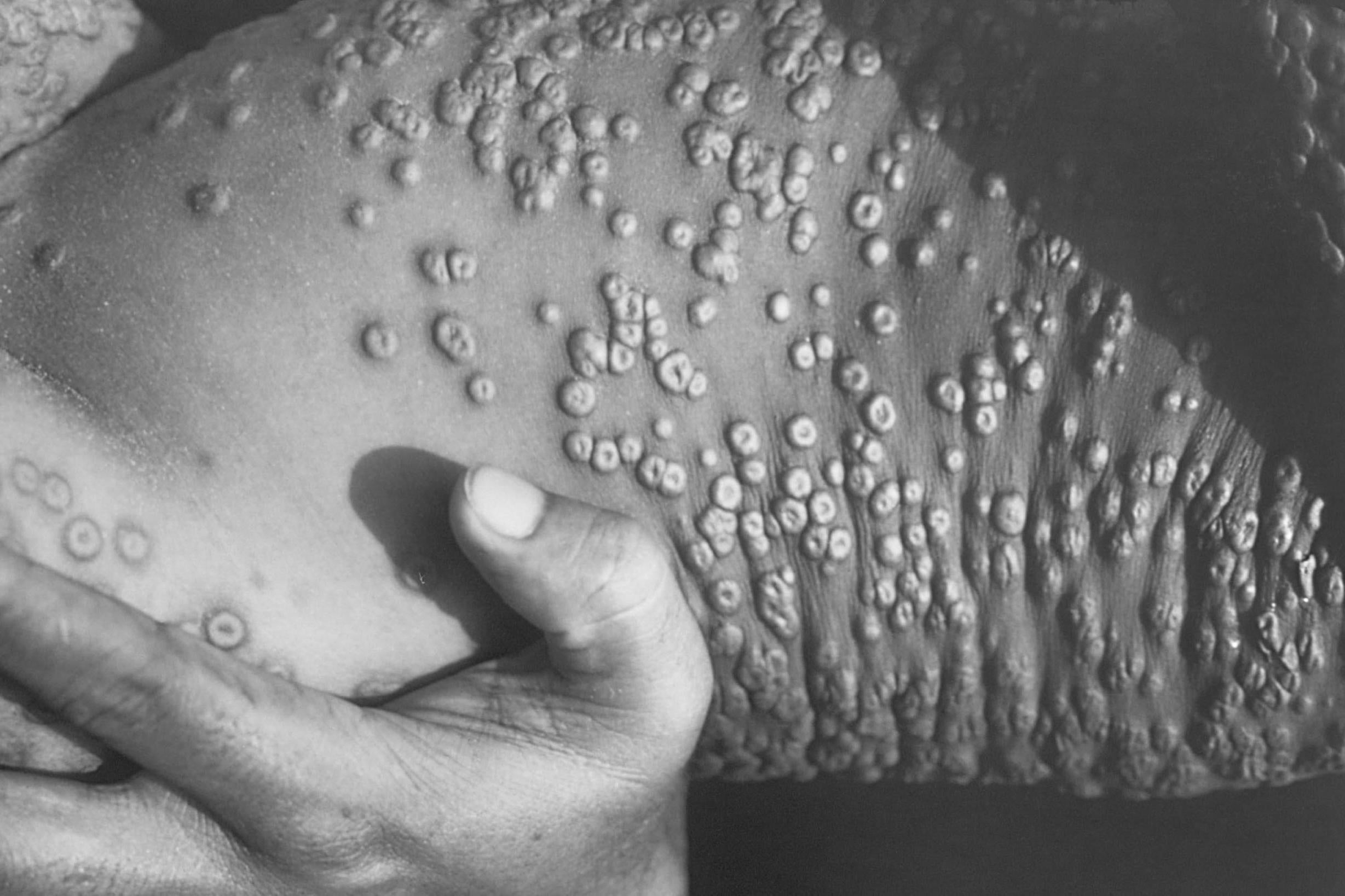 Smallpox lesions develop as the disease progresses (Getty)