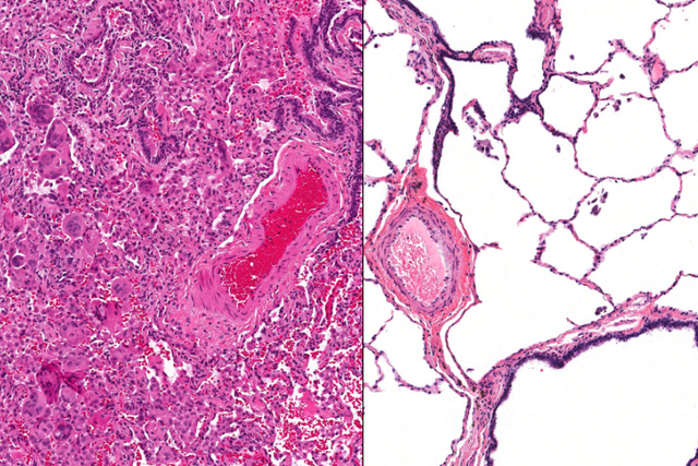 The patient's lung tissue under the microscope (left) and healthy lung tissue under the microscope (right).
