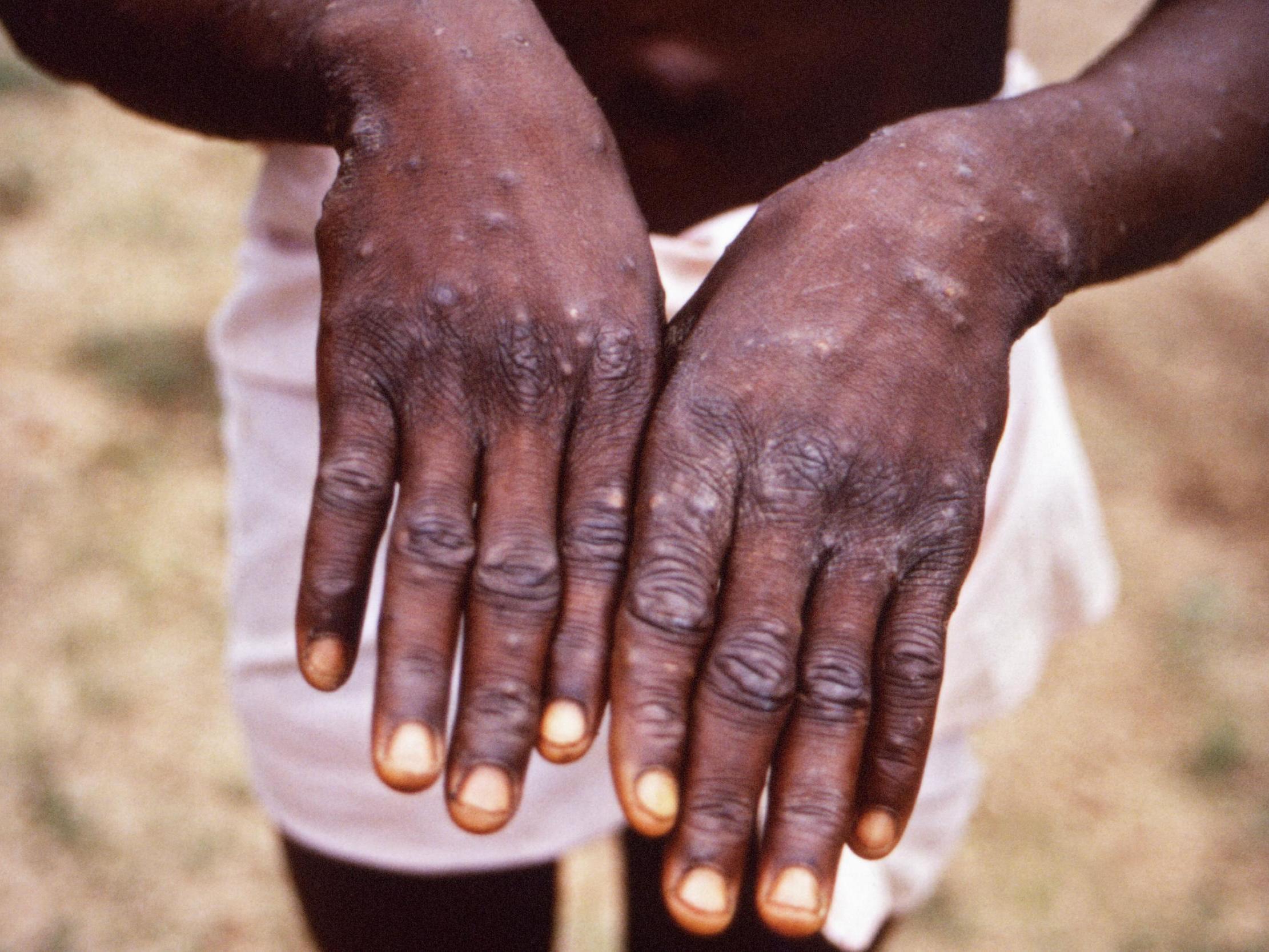 Monkeypox is a rare viral infection that does not spread easily between people