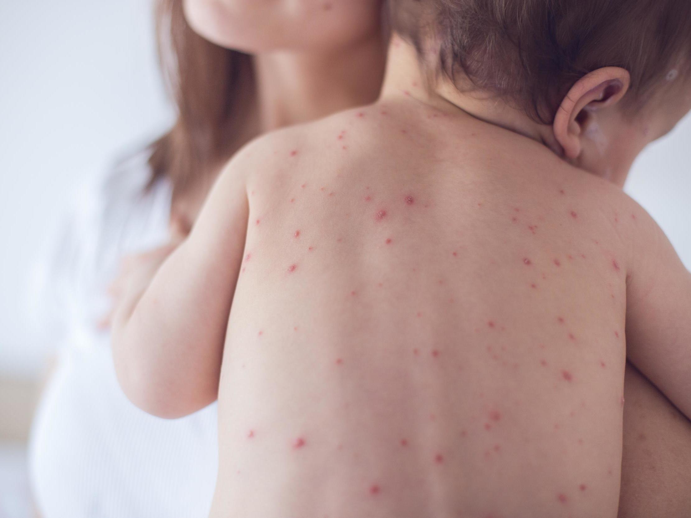 More than 140,000 people died from measles in 2018, according to estimates from WHO