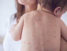 Coronavirus: Millions of children at risk from measles as vaccination programmes stopped during pandemic
