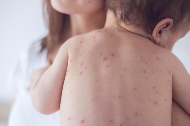 More than 140,000 people died from measles in 2018, according to estimates from WHO