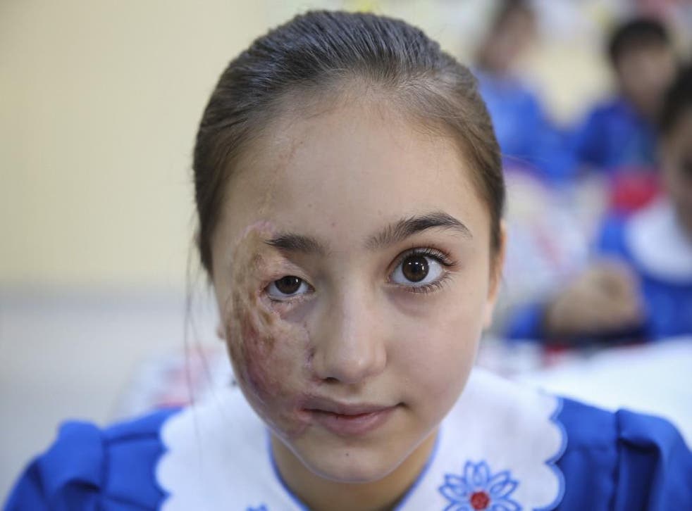 Luceyn Kifretune, a nine-year-old Syrian girl who lost four of her family and had her face permanently scarred in a barrel-bomb attack
