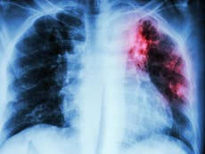 Injecting TB vaccine directly into the bloodstream could save lives worldwide, suggests new study