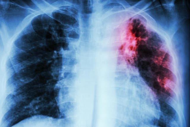Existing TB vaccine is unreliable against the form of disease which attacks the lungs, the most prevalent form of infection