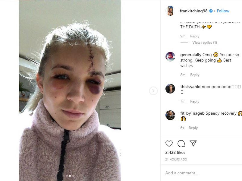 Kitching posted a picture of her injury on her Instagram page