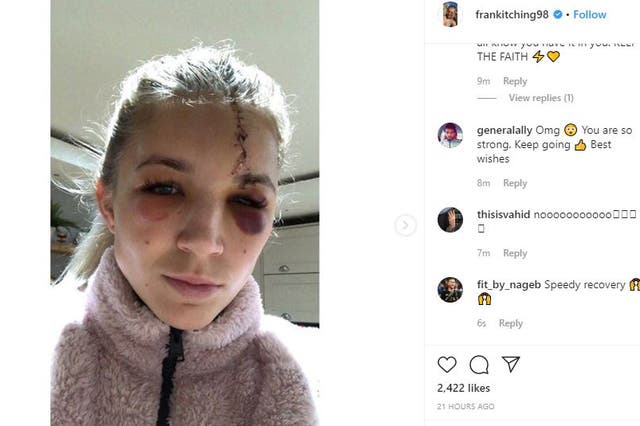 Kitching posted a picture of her injury on her Instagram page