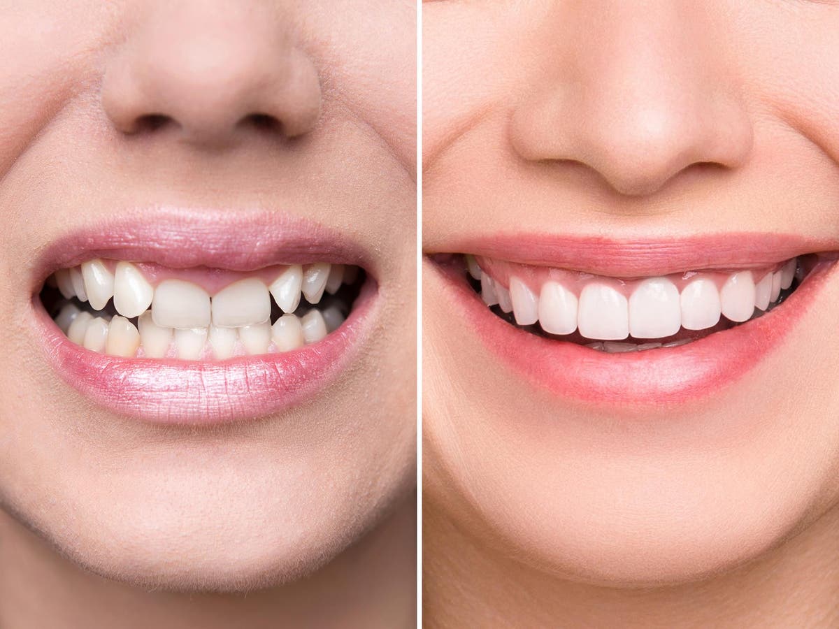 Invisalign charges SmileDirectClub made false claims about care from real  dentists in its ads