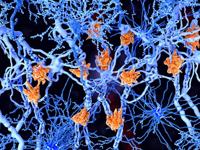 <p>Microglia cells (orange) attack the oligodendrocytes that form the insulating myelin sheath around neuron axons, leading to the destruction of the myelin sheath and to the loss of nerve function</p>