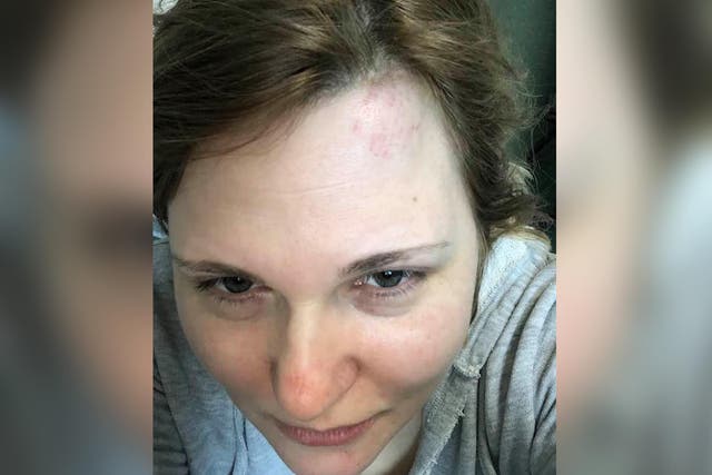 Investigative journalist shows a mark on her head after being attacked