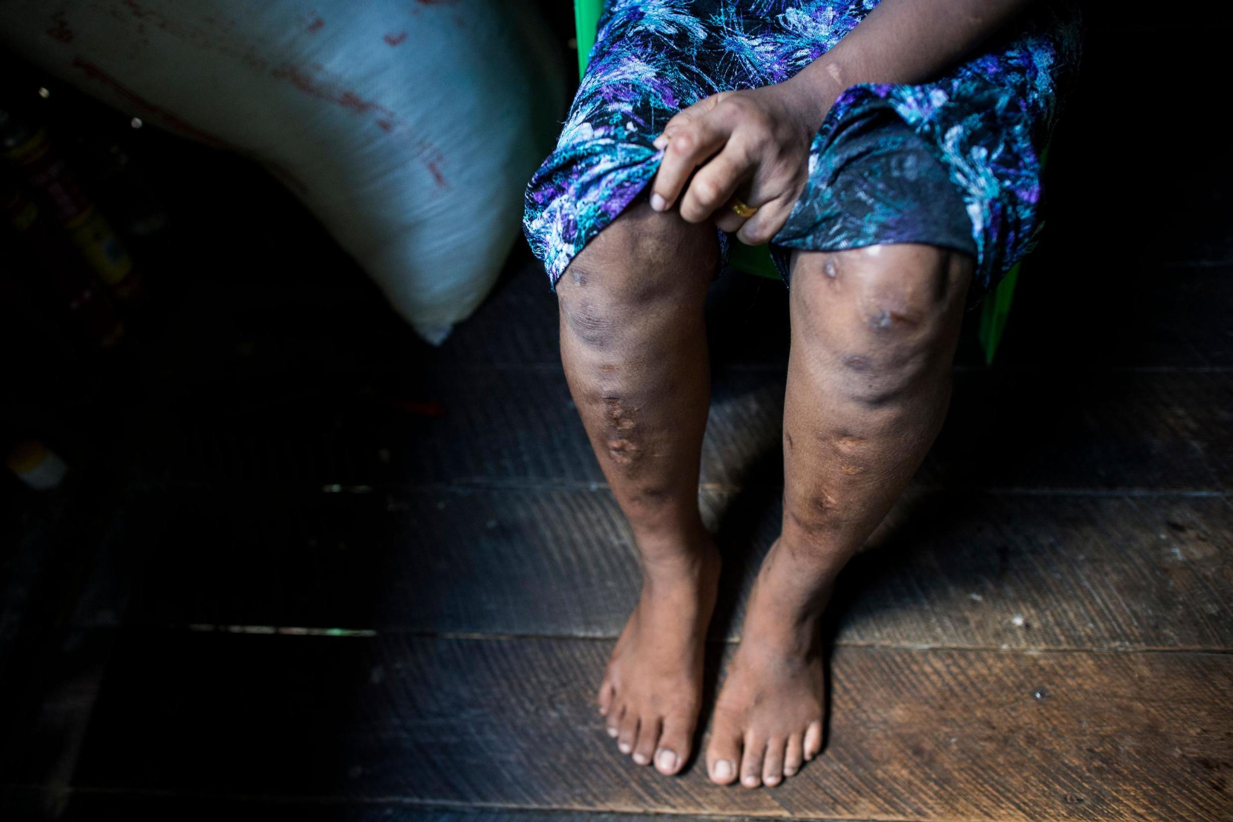 A 16-year old Myanmar child slave, with deep scars, recovers in a relative’s house (AFP/Getty)