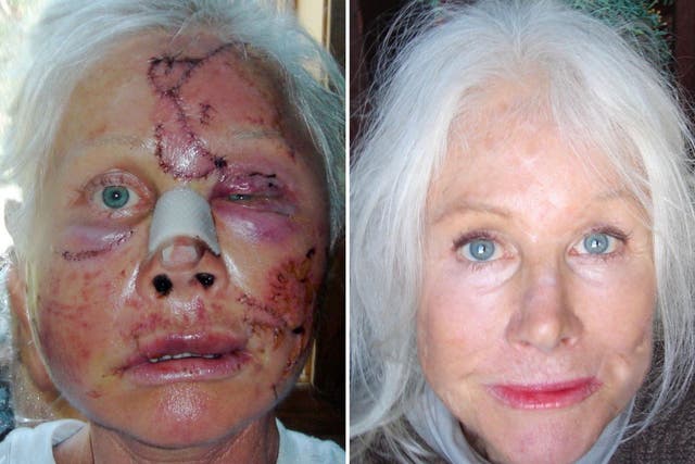 Allena Hansen (pictured then and now) says the aftermath of her bear attack in 2008 was worse than the actual attack