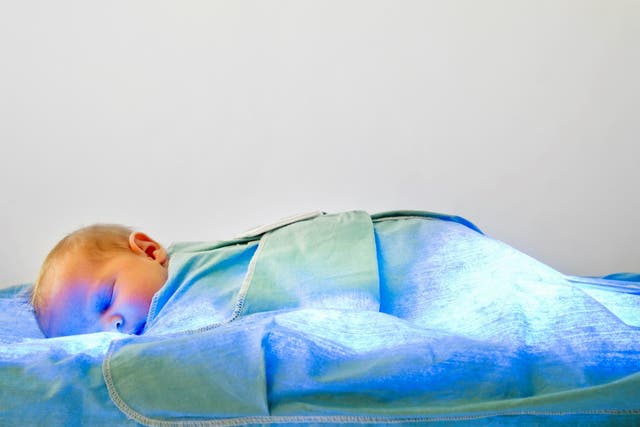 A newborn girl undergoing phototherapy treatment for jaundice,  a very common newborn condition