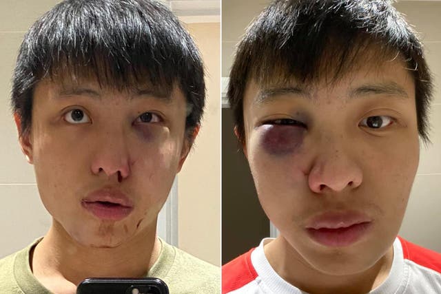 <p>Singaporean law student Jonathan Mok, 24, suffered fractured nose and broken cheekbone following assault on Oxford Street and needed surgery on his face</p>