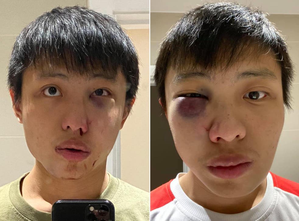 <p>Singaporean law student Jonathan Mok, 24, suffered fractured nose and broken cheekbone following assault on Oxford Street and needed surgery on his face</p>