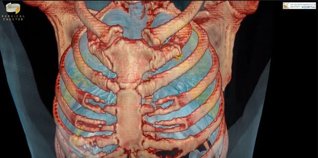 A lung infected with coronavirus