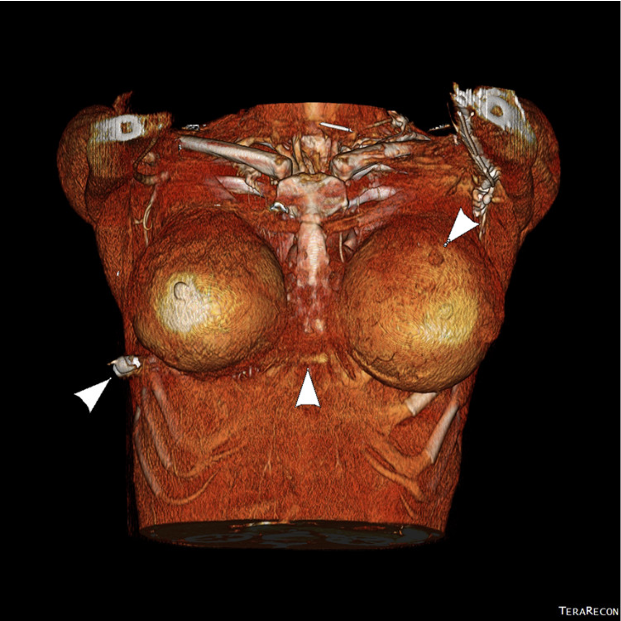 3-dimensional rendered image showing left breast entry wound (right arrow), tract of bullet with disruption of presternal soft tissues (middle arrow), and bullet in right lateral chest wall (left arrow)